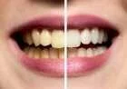 كيفية جعل الأسنان بيضاء