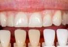 تغيّر لون الأسنان، الأسباب والعلاج