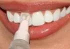 كيف يتم تبييض الاسنان