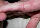 ما هي أنواع حساسية الجلد