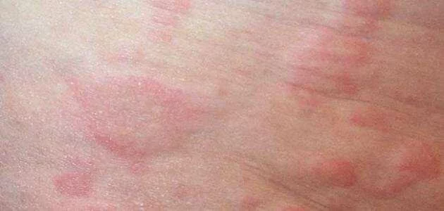 كيفية علاج حساسية الجلد